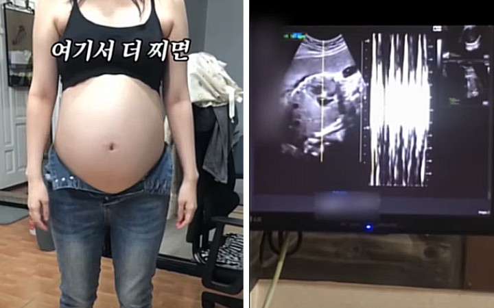 Verejnosť hovorí o barbarstve, to isté sa však v tichosti deje aj na amerických potratových klinikách